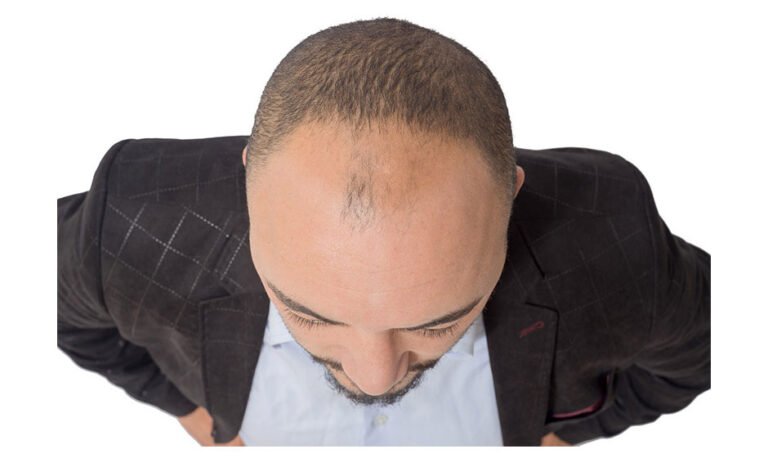 Why Do Men Suffer Baldness and Women Don't?