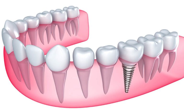 What Makes Dental Implants the Gold Standard in Tooth Replacement?